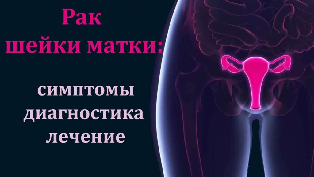 Рак шейки матки. Как уберечь себя от страшного диагноза